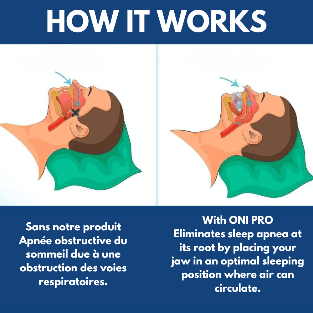 Orthèse ONI Pro contre ronflements et apnée du sommeil