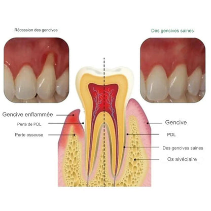 Gel de thérapie gingivale